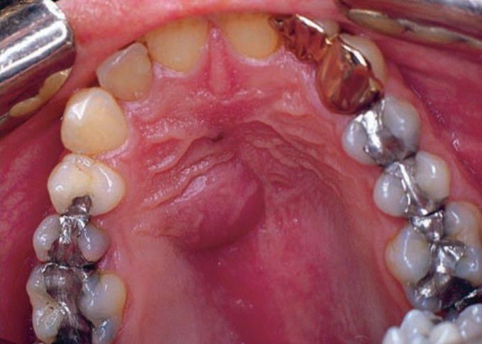 Palatal abscess