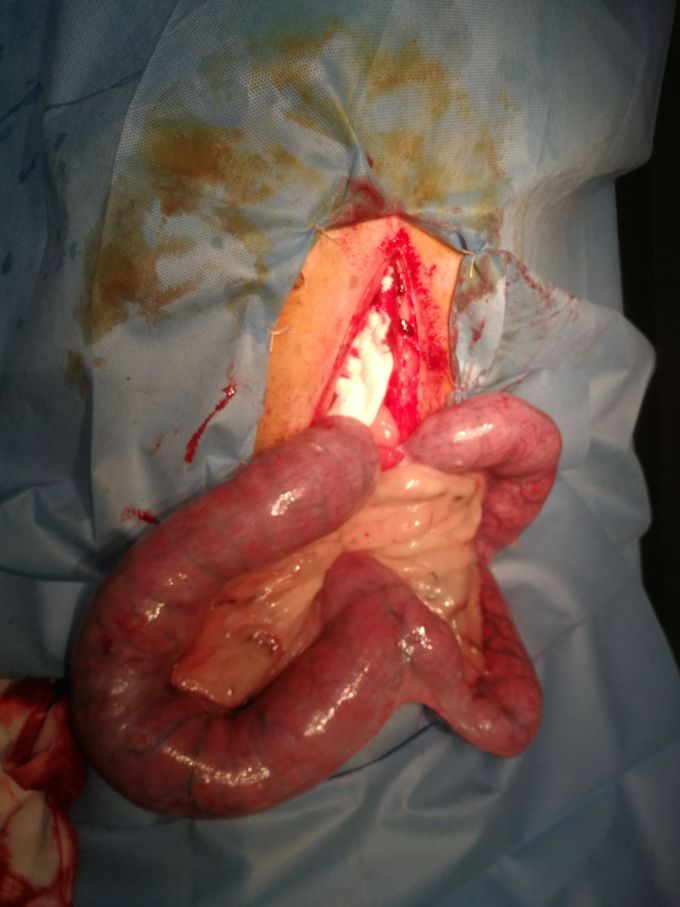 Pyometra-inflammation of the uterus