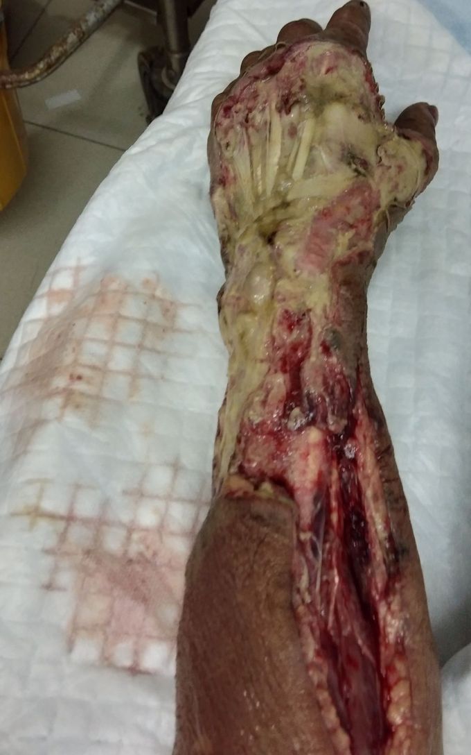 Received a patient sustaining tissue injury after an insect bite