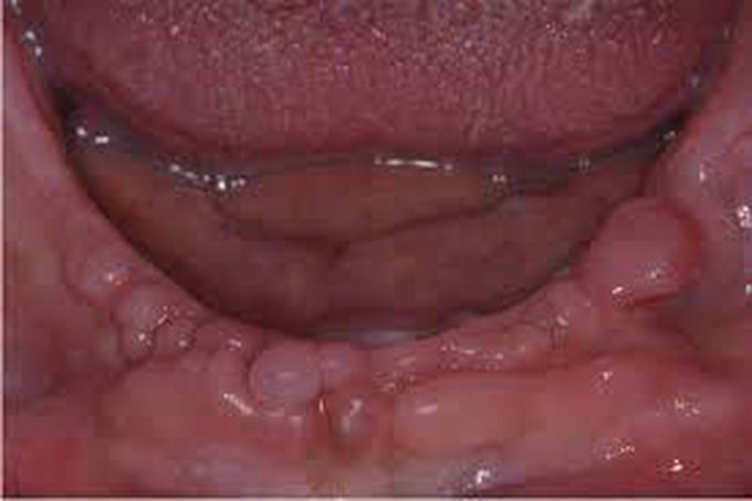 Symptoms of denture induced hyperplasia