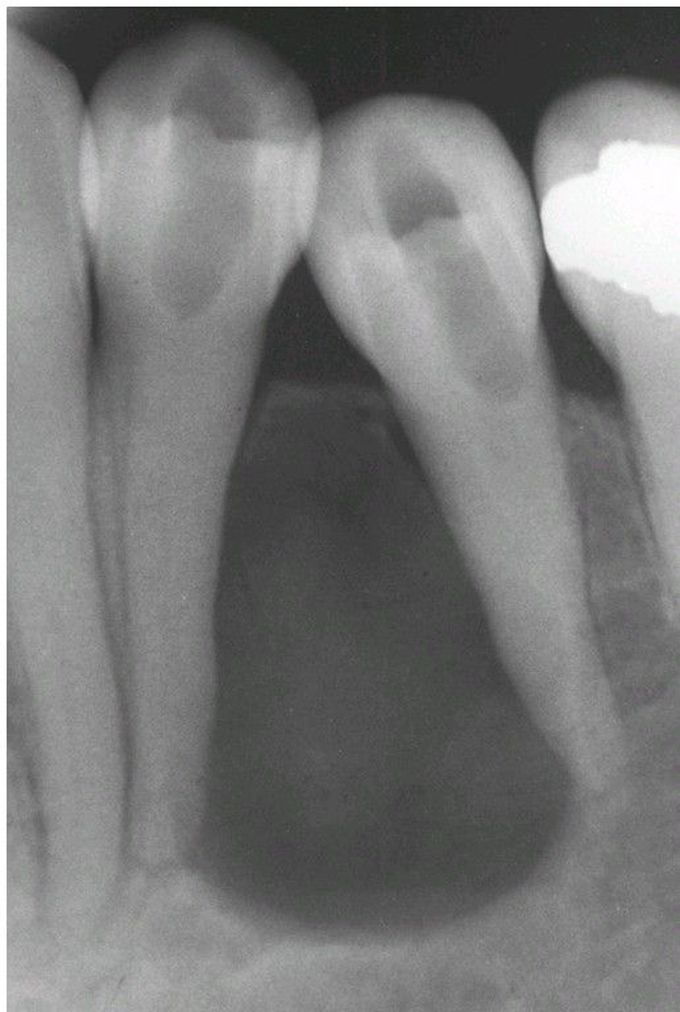 Lateral Periodontal Cyst.