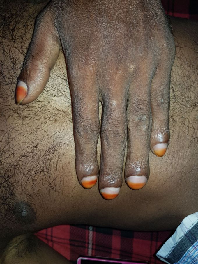 Idiopathic Clubbing