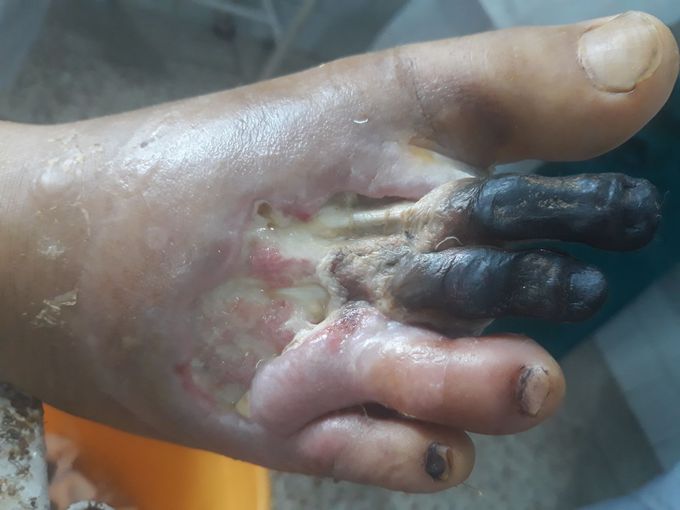 cellulitis/gangrene