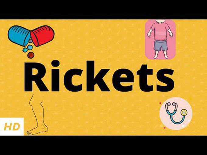 Rickets - Animation