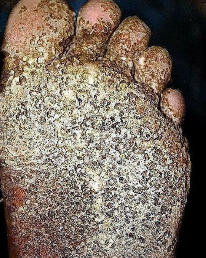 Pitted keratolysis