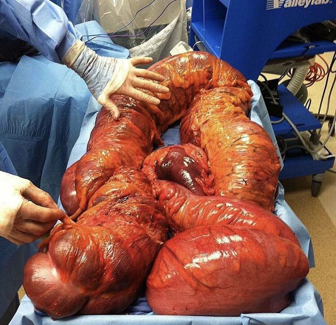 Toxic Megacolon