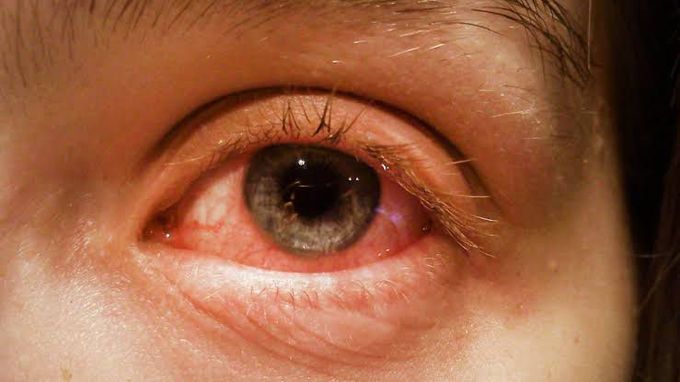 Conjunctivitis causes