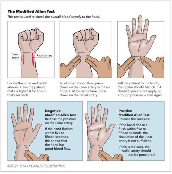 Modified Allen Test