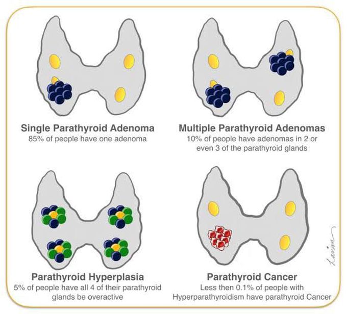 Pathology of parathyroid gland