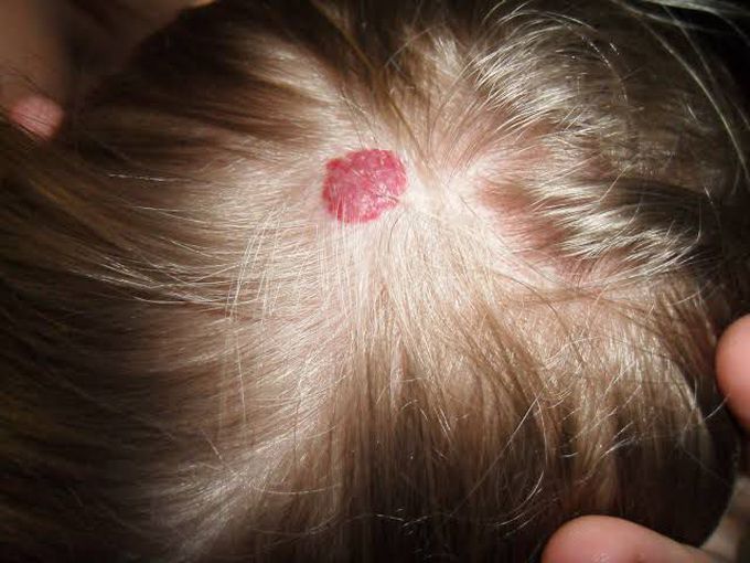 Hemangioma