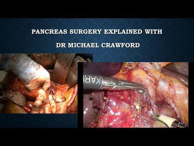 Pancreas-Surgery