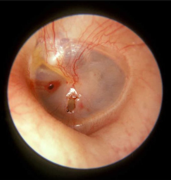 Left tympanic membrane traumatic perforation