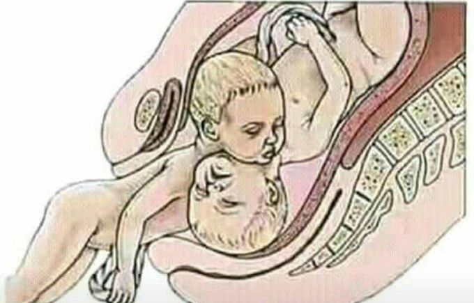 How can this birth complication be sloved?