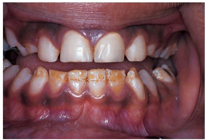 Chronological hypoplasia