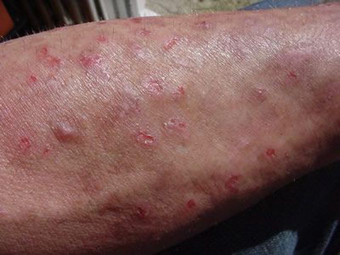 Morgellons