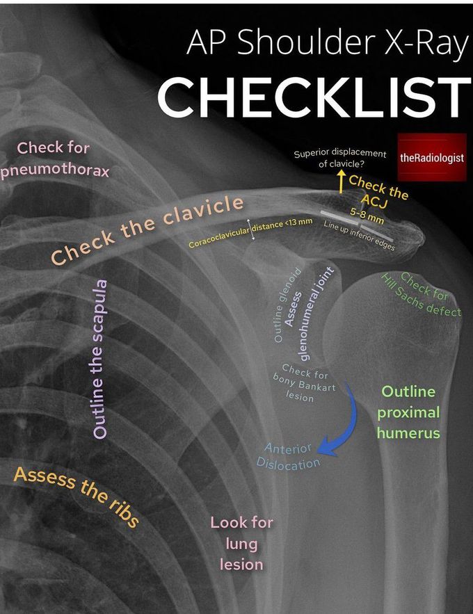 AP Shoulder X-ray