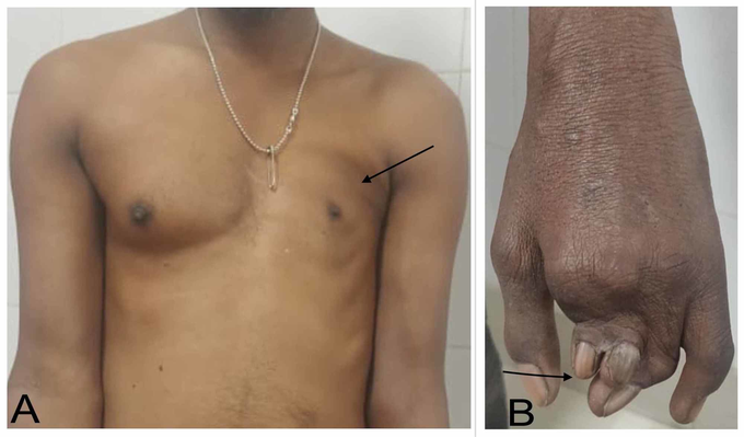 Poland Syndrome