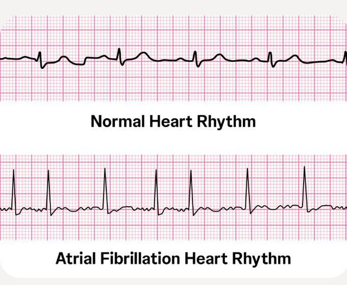 Atrial fibrillation