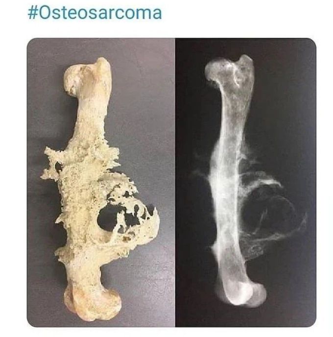 Osteosarcoma