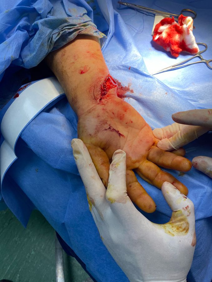 VLC radio-carpal, rupture tendini
