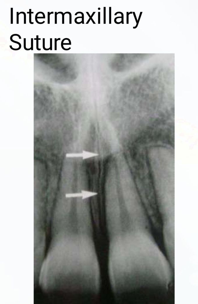 Intermaxillary Suture