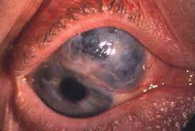 Scleromalacia Perforans: A Rare Anterior Uveitis