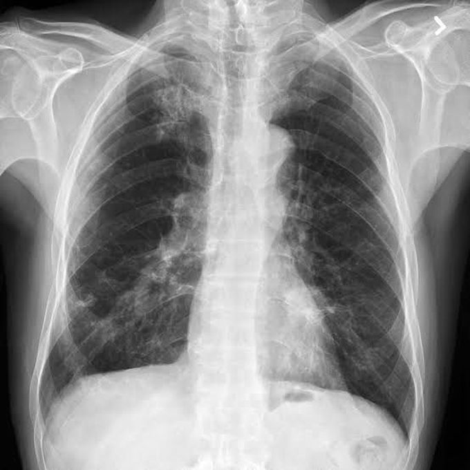 Bronchogenic carcinoma