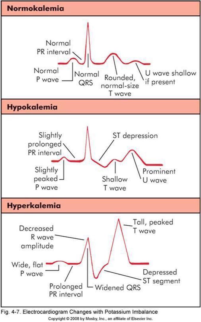 ECG changes with Potassium(k) imbalance