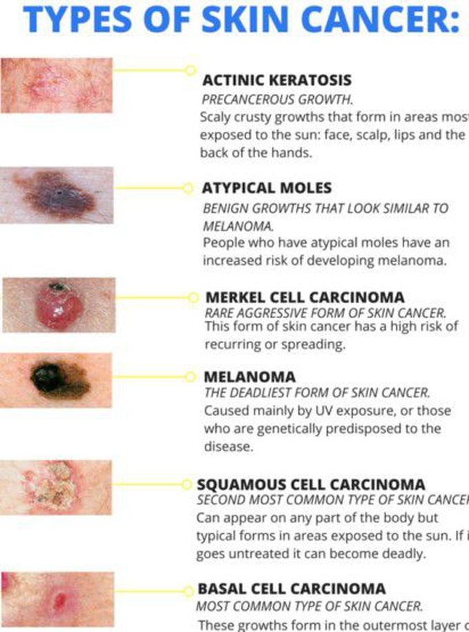 Types of skin cancer