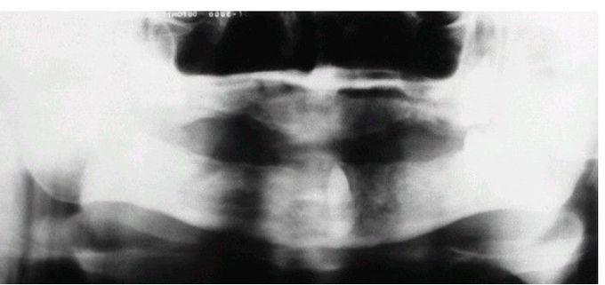 Impacted tooth under prosthesis