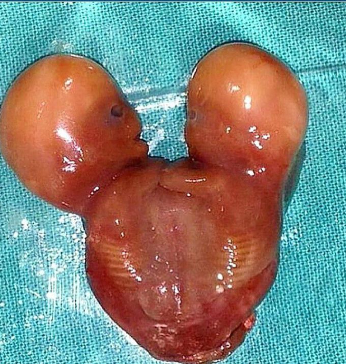 Conjoined twins