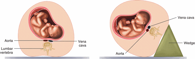 Aortocaval Compression