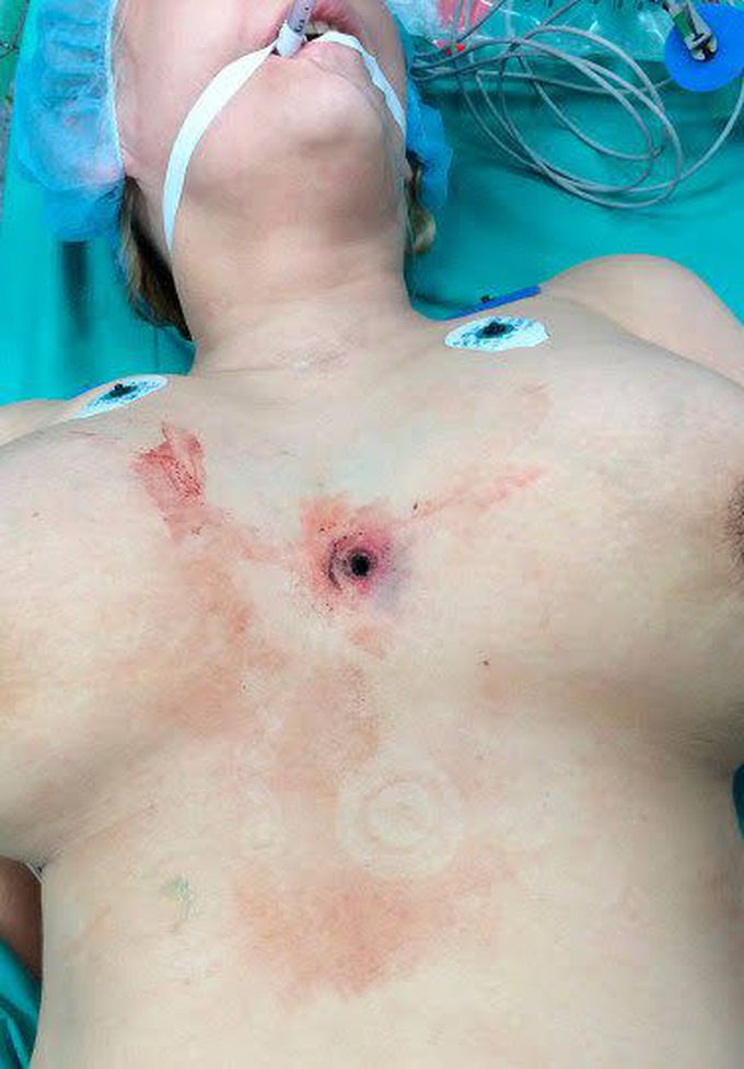 Gunshot wound