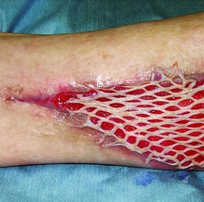 Mesh skin grafting! 