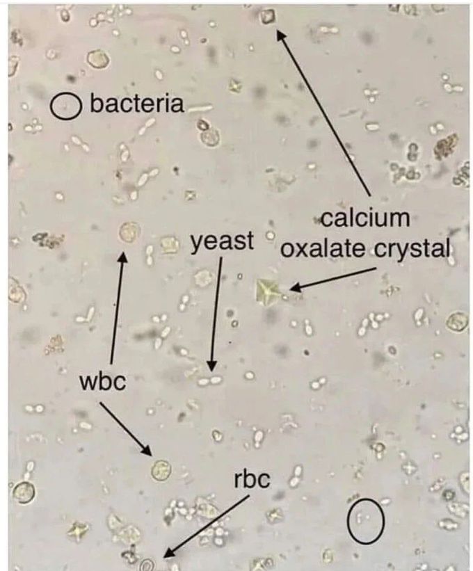 Urine Analysis