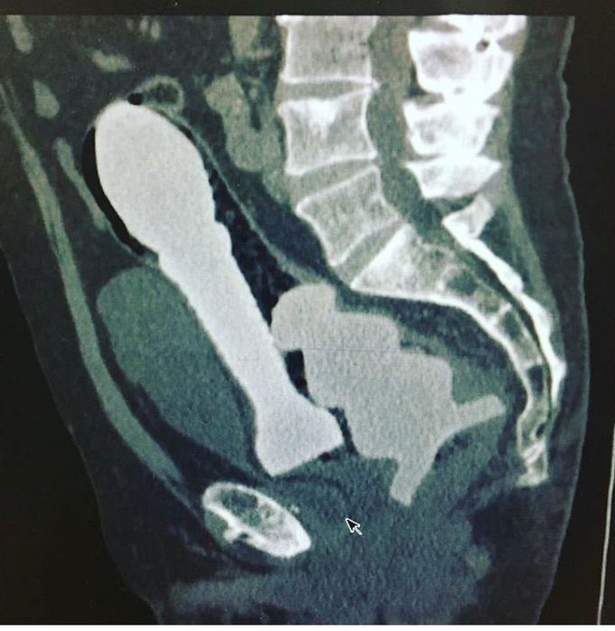 Sliding into Monday late to work like....
Ok so a not so glamorous part of my job is removing “foreign bodies” from various parts of the human body. This is a CT scan (not mine) of not one but two toys impacted into the rectum😳😳😳                          Source; Dr Buck Parker
