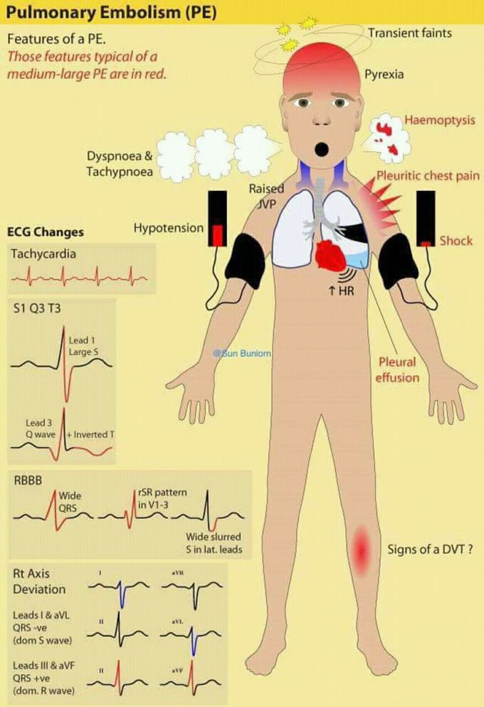 Pulmonary Embolism