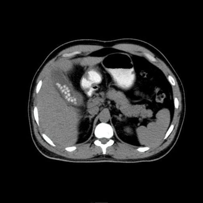 Acute calculus cholecystitis