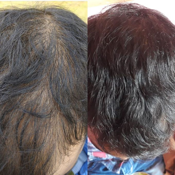 My treatment to a patient with massive hair loss