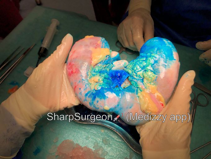 Here we go again- Smurf’s kidney⁉️😨