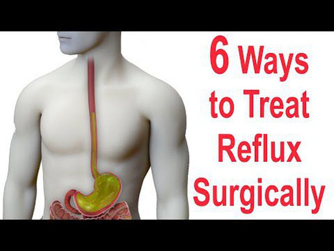 Surgical Repair of Reflux: Various Approaches
