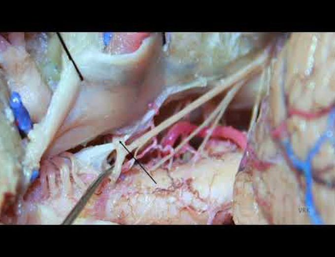 Far lateral approach for microsurgical ligation of C1 dAVF: surgical anatomy and technical nuances
