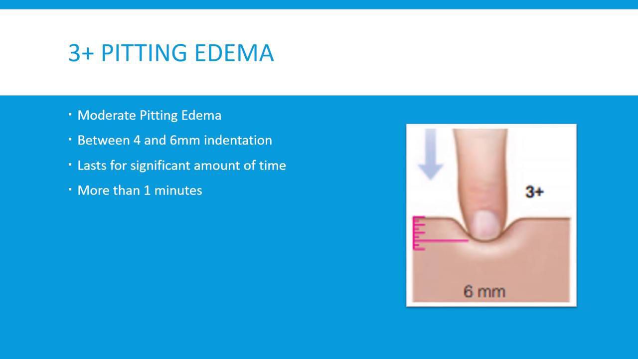 4+ pitting edema