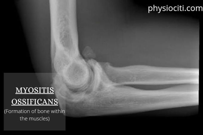 Myositis Ossificans: Types, Features, & Treatment. - physiociti