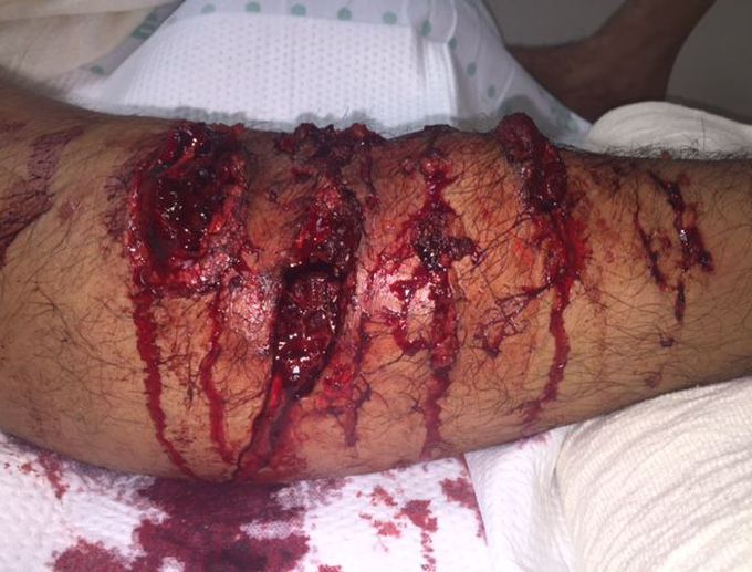 Antibiotic of Choice in Dog Bite Injuries
