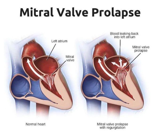 Mitral valve prolapse