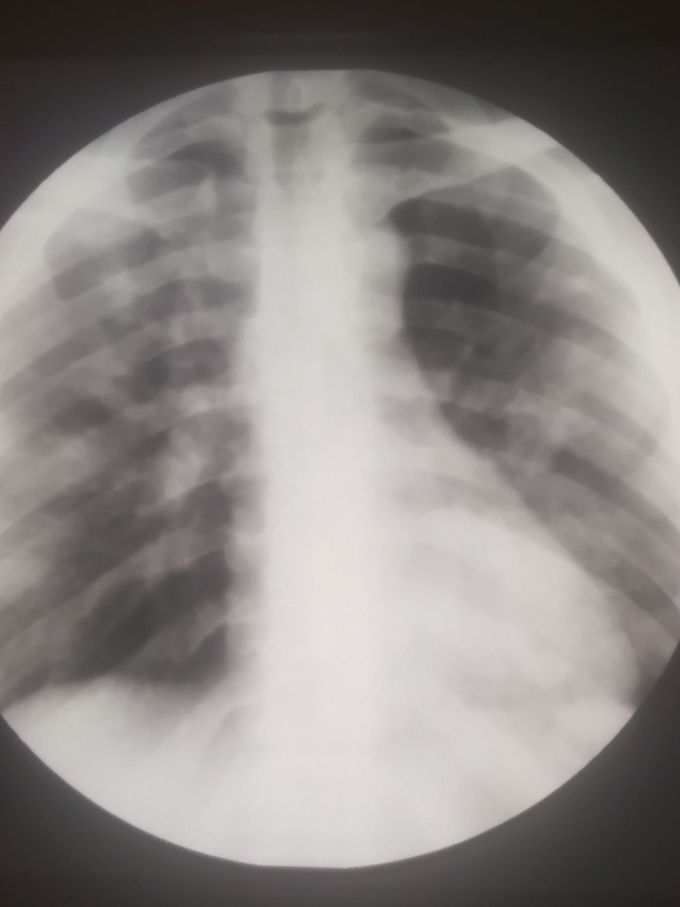 Covid-19 during treatment