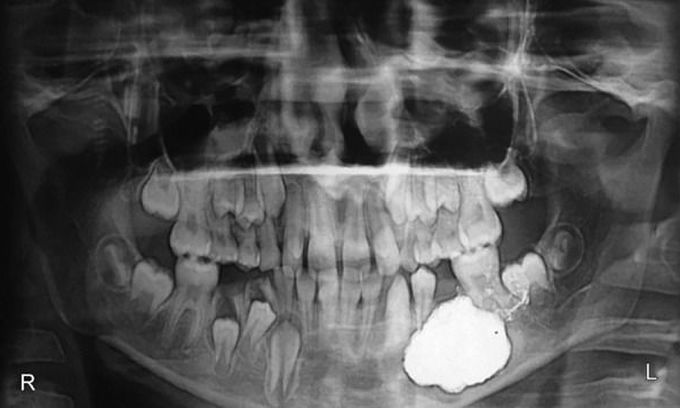 Dentigerous cyst in a young child