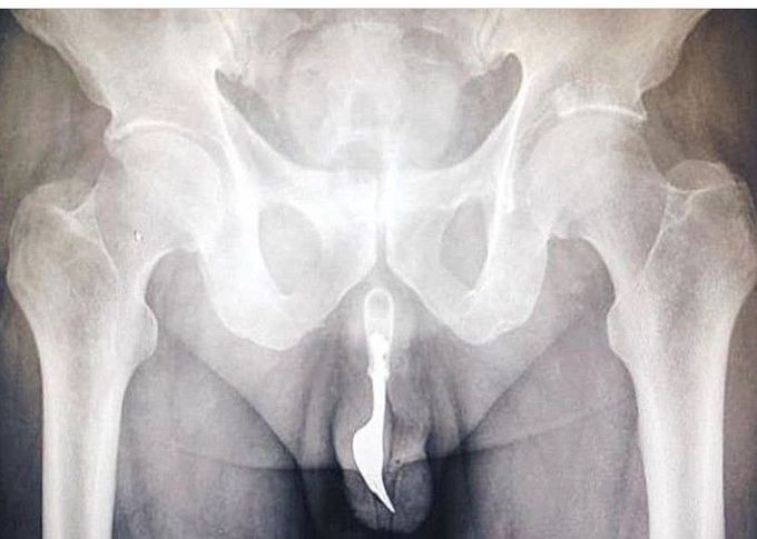 Something stuck in male sex organ!