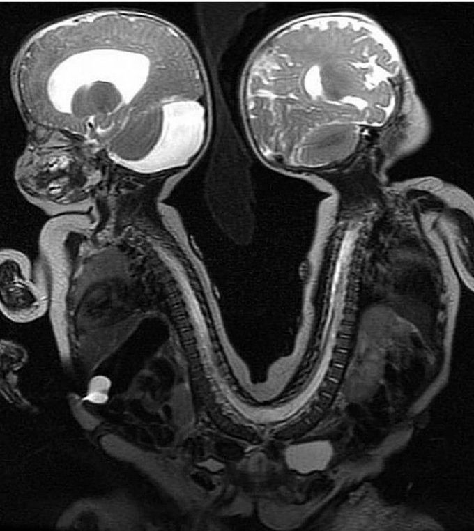 Conjoined twins successfully separated